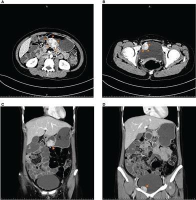Bladder paraganglioma, gastrointestinal stromal tumor, and SDHB germline mutation in a patient with Carney-Stratakis syndrome: A case report and literature review